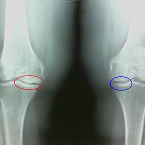Artrosis of knee joint in radiography