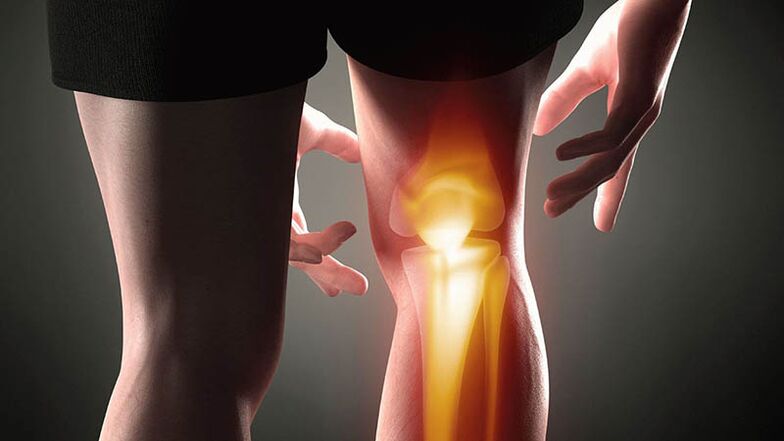 Artrosis of knee joint