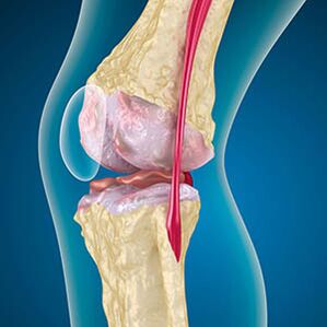 The extreme tension of the bud muscle causes pain in the knee